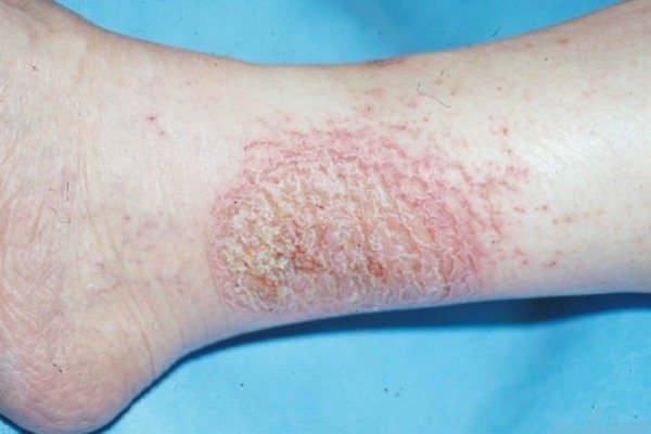 Microbial eczema