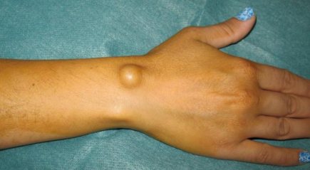 In the photo: Lipoma on the arm