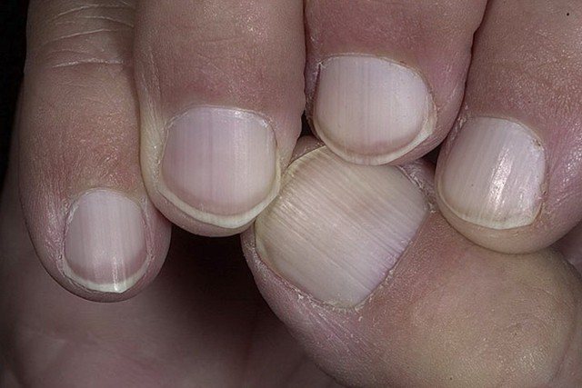 Нити мицелия на ногтях: лечение медицинскими препаратами и народными средствами