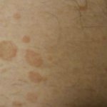 О чем свидетельствуют коричневые пятна на коже?