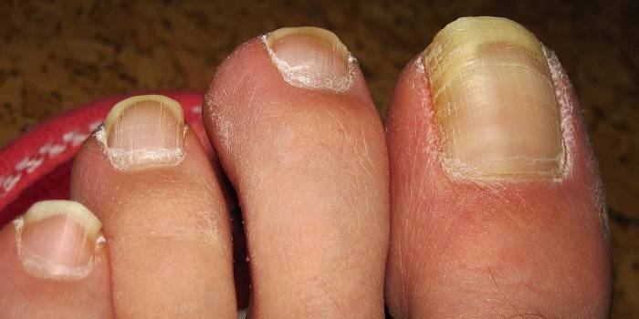 Onychomycosis on toenails