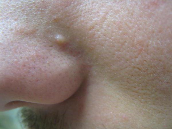 pearly papules in men
