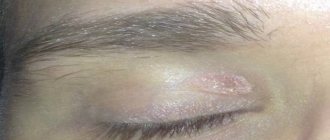 Почему появляются трещины и шелушение кожи вокруг глаз