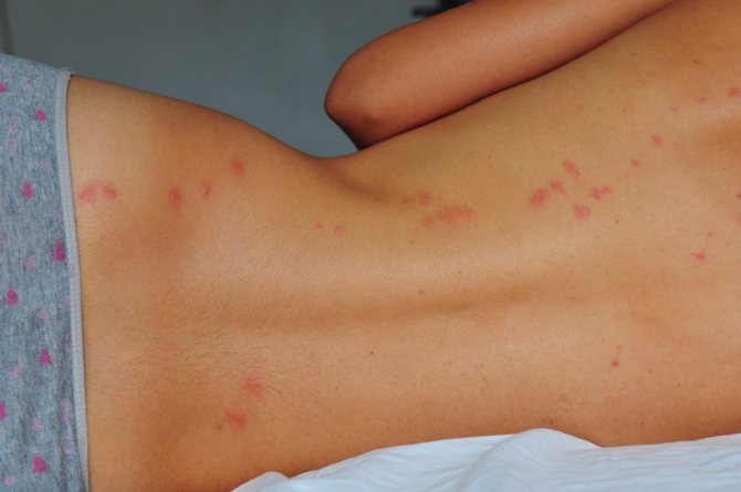 Причинами кожной аллергии могут быть лекарственные препараты, бытовая химия и косметические средства