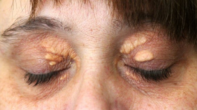 Causes and methods of removing yellow spots on the eyelids