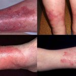 Проявление застойного дерматита на ногах