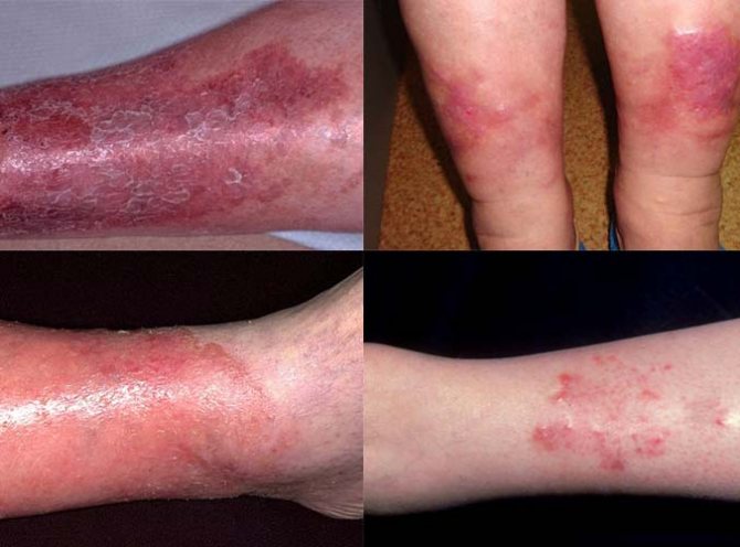 Проявление застойного дерматита на ногах