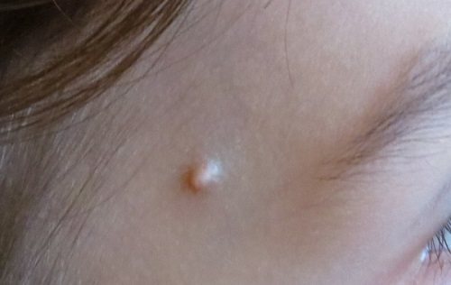 A pimple on the temple may appear due to poor hygiene