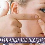 Прыщи на щеках: причины, лечение и отзывы