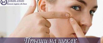 Прыщи на щеках: причины, лечение и отзывы