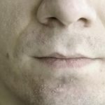 Прыщи после бритья: почему они возникают и как с ними бороться