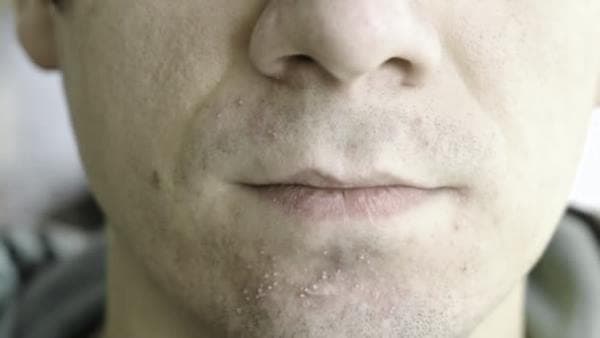 Pimples after shaving: why they occur and how to deal with them