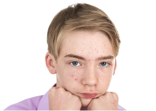 Acne in a teenager