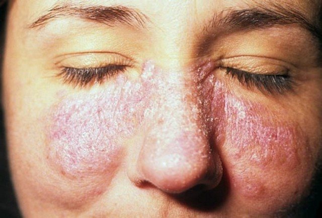 Psoriasis on the face