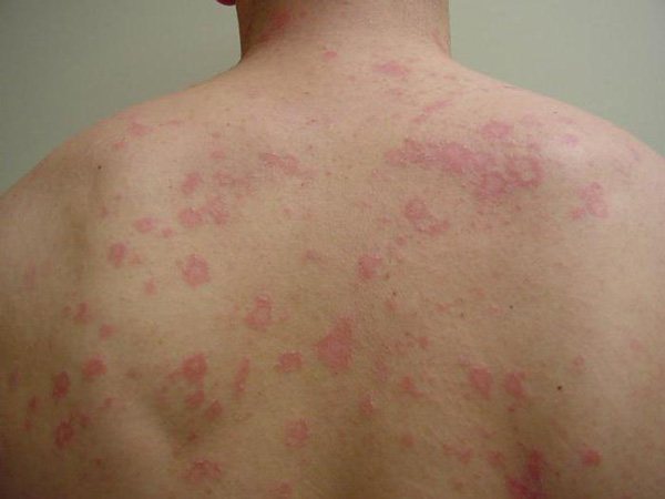 spots on the body due to syphilis