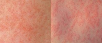 Measles and rubella spots
