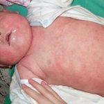 Распространение атопического дерматита по всему телу чаще бывает при перекармливании младенца