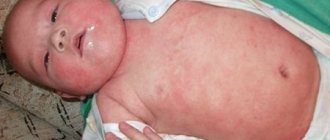 Распространение атопического дерматита по всему телу чаще бывает при перекармливании младенца