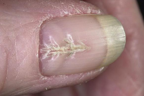 Расщепление в середине ногтя может возникнуть из-за маникюра