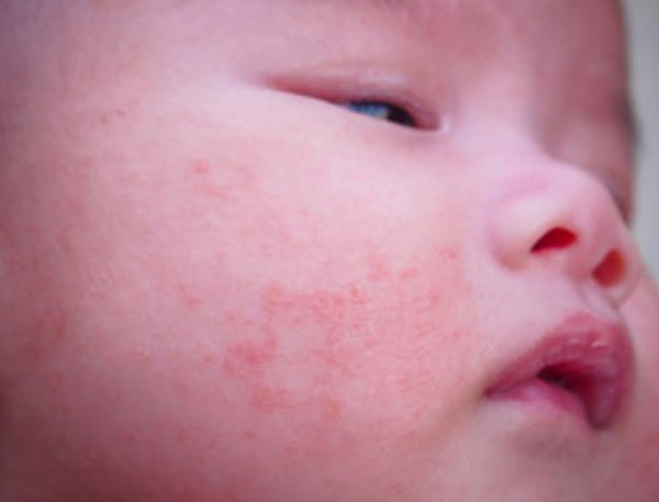 Ребенок с аллергией