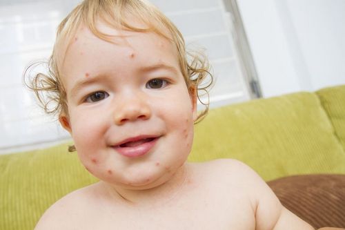 child with herpes