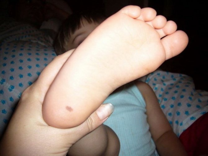 Mole on a child&#39;s heel