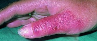 рожистое воспаление на пальце