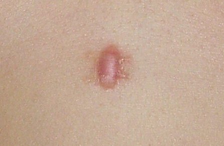 Scar after wart removal