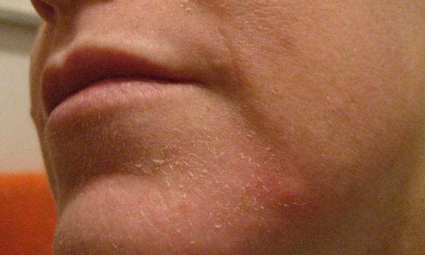 Peeling skin on the face: what is it associated with and what to do?