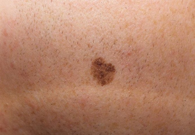 Methods for treating moles