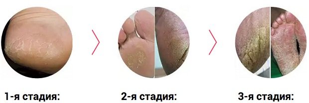 Stages of mycosis of the feet