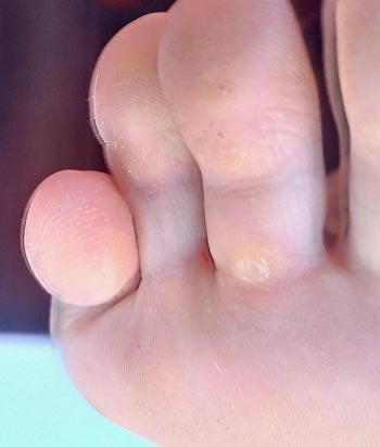 dry callus between toes photo