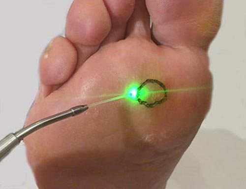 Dry callus can be removed with laser