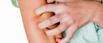 Сыпь на коже рук при беременности