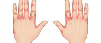 Сыпь на пальцах рук: причины возникновения и способы лечения