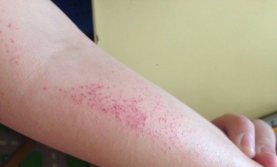 Rash on hands in the form of small pimples photo