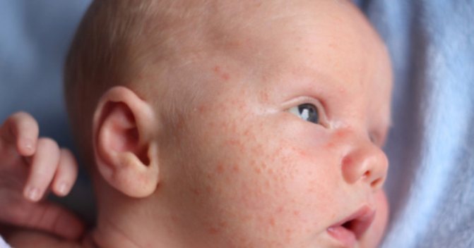 Сыпь на теле у ребенка мелкая и красная: виды, причины и лечение
