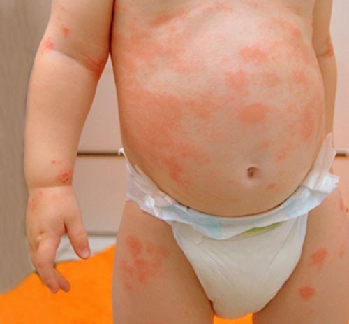 Temperature and spots on the child’s body