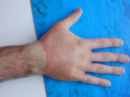 Требующий лечения дерматит на руках