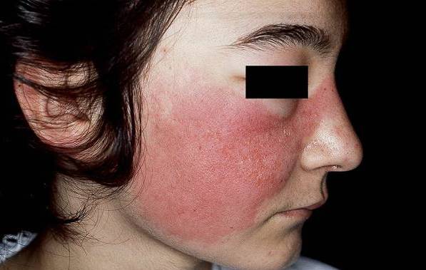 Skin tuberculosis photo initial stage 2