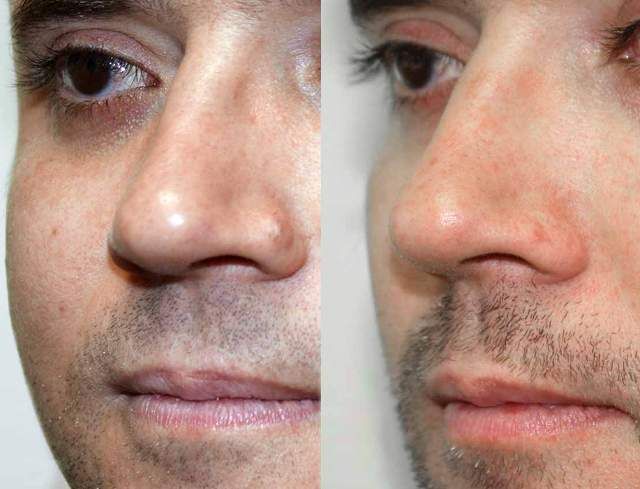 Удаление бородавки: до и после