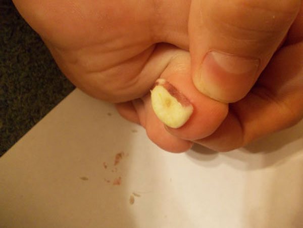 removing warts with garlic