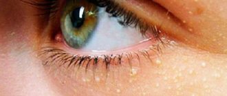 Удаление жировиков в области глаз лучше доверить косметологу, не пытаясь избавиться от кожного дефекта самостоятельно