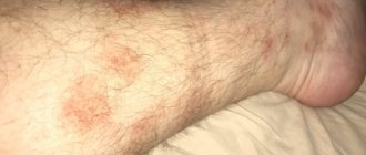 Варикозный дерматит нижних конечностей: лечение и симптомы