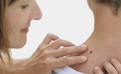 Types of warts on the neck
