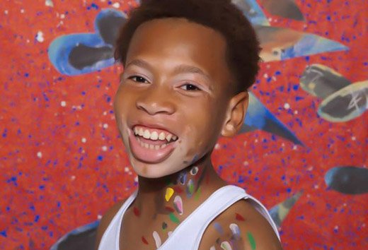 vitiligo in a child