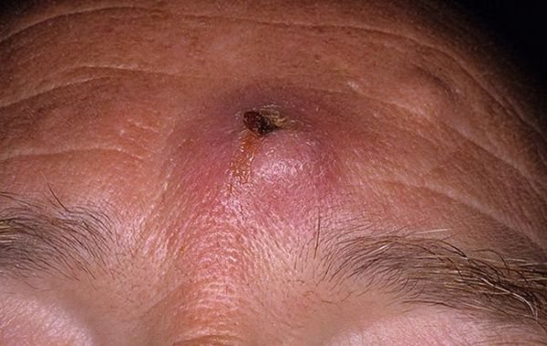 Inflammation of the sebaceous glands on the head