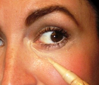 Yellow under the eyes: causes and what to do