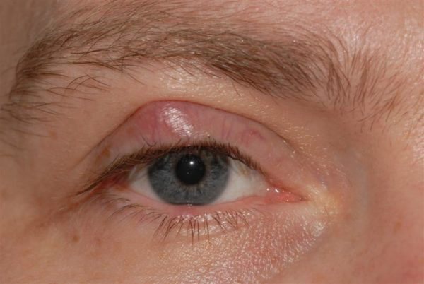 Wen on the eyelid photo and treatment 1