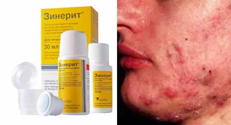 zeneritis for acne reviews